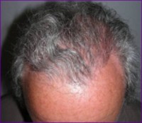 After hair restoration